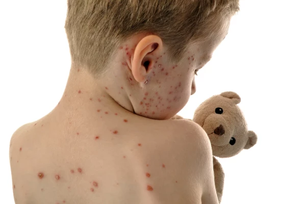 Measles Cases On The Rise In England